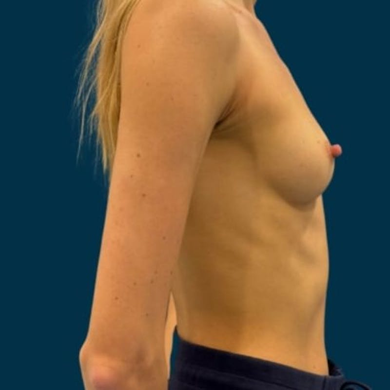 Breast Augmentation Before & After Gallery - Patient 132975 - Image 3