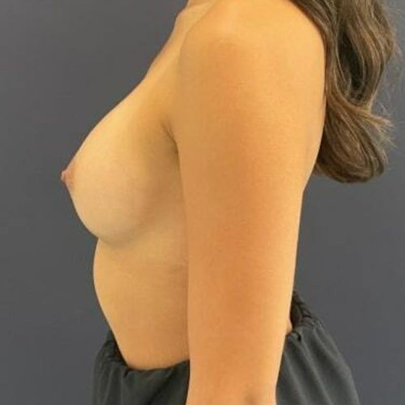 Breast Augmentation Before & After Gallery - Patient 980660 - Image 6
