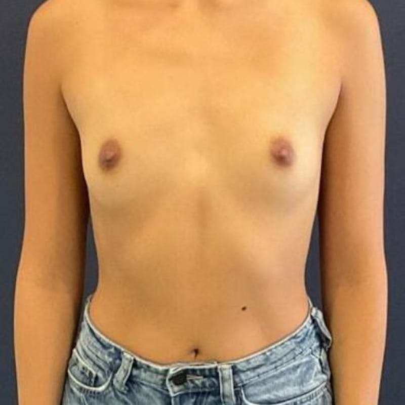 Breast Augmentation Before & After Gallery - Patient 980660 - Image 7