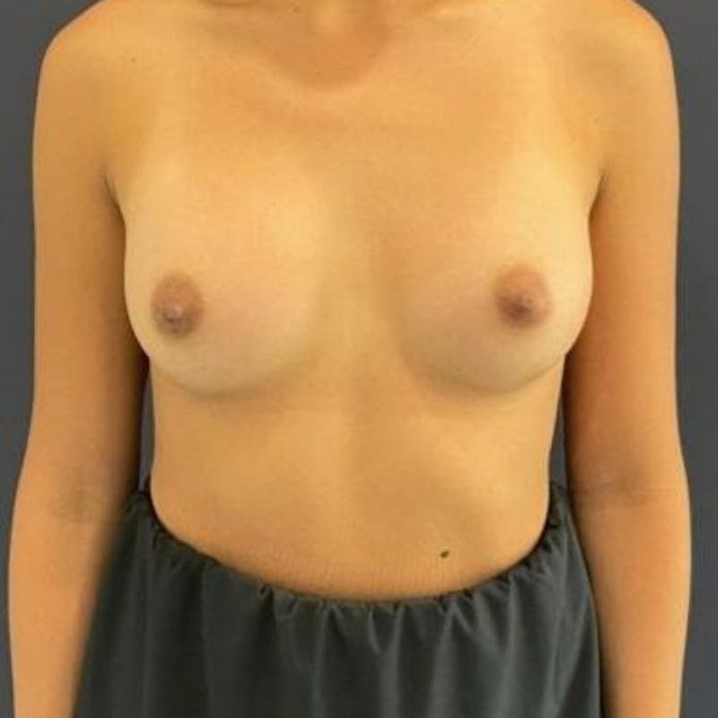 Breast Augmentation Before & After Gallery - Patient 980660 - Image 8