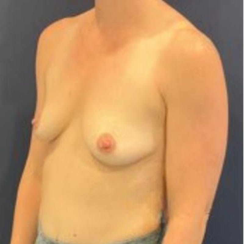 Breast Augmentation Before & After Gallery - Patient 174477 - Image 3