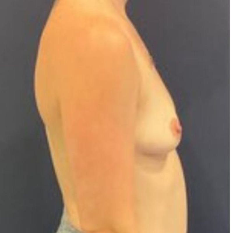 Breast Augmentation Before & After Gallery - Patient 174477 - Image 5