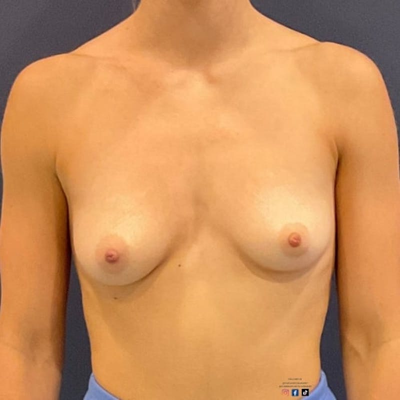 Breast Augmentation Before & After Gallery - Patient 698992 - Image 1