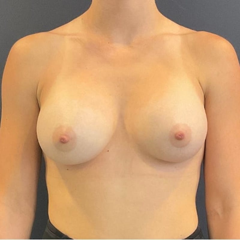 Breast Augmentation Before & After Gallery - Patient 698992 - Image 2