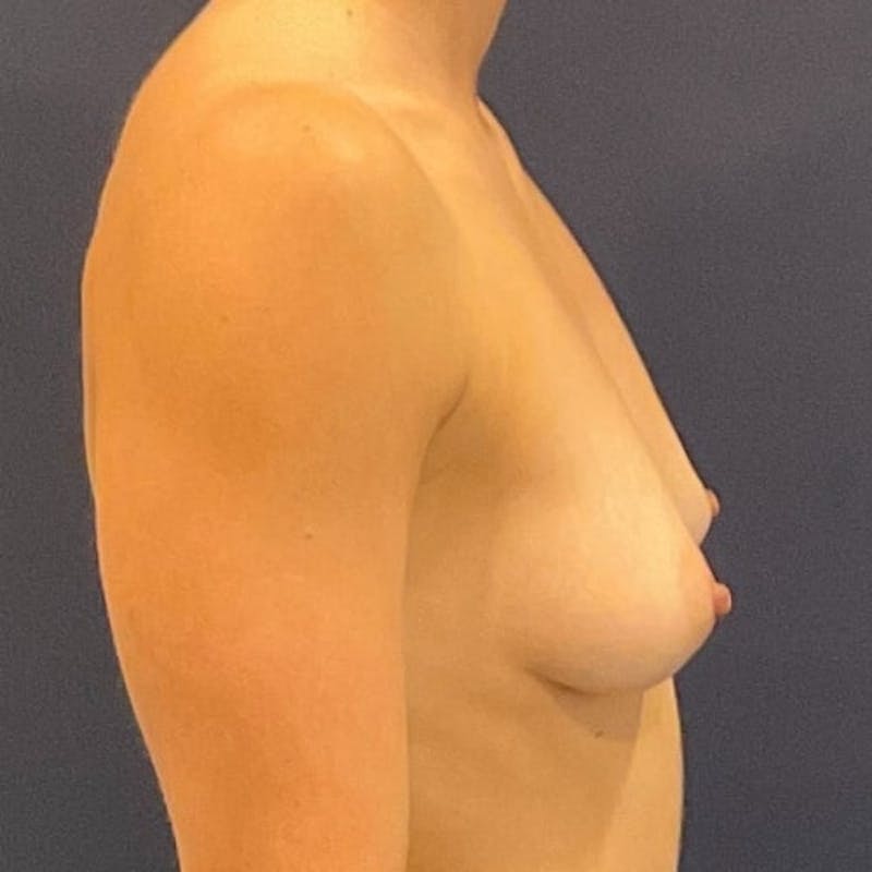 Breast Augmentation Before & After Gallery - Patient 698992 - Image 5