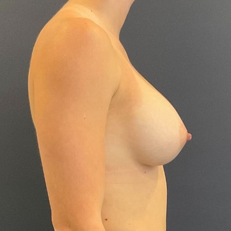 Breast Augmentation Before & After Gallery - Patient 698992 - Image 6
