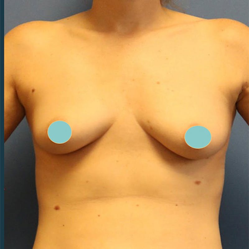 Breast Augmentation Before & After Gallery - Patient 126375 - Image 1