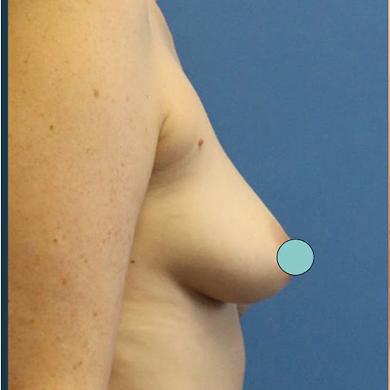Breast Augmentation Before & After Gallery - Patient 126375 - Image 3
