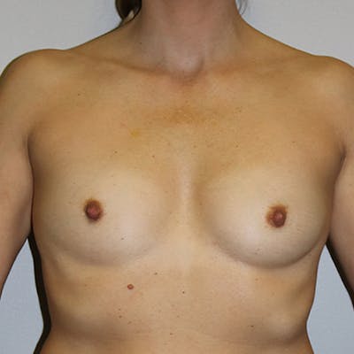 Breast Augmentation Before & After Gallery - Patient 139692 - Image 1