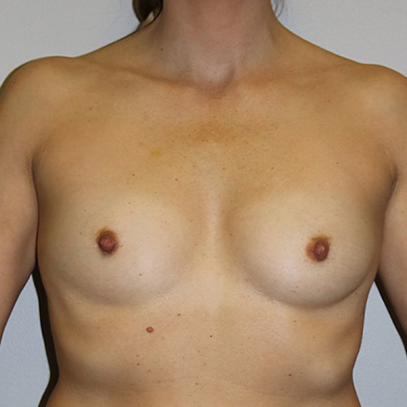 Breast Augmentation Before & After Gallery - Patient 139692 - Image 1