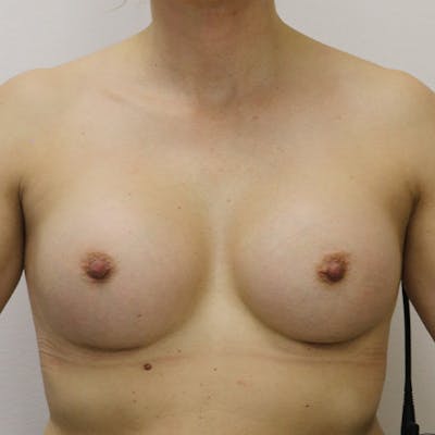 Breast Augmentation Before & After Gallery - Patient 139692 - Image 2