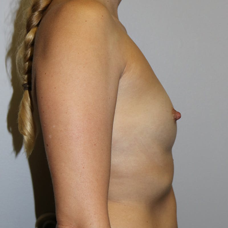 Breast Augmentation Before & After Gallery - Patient 139692 - Image 5