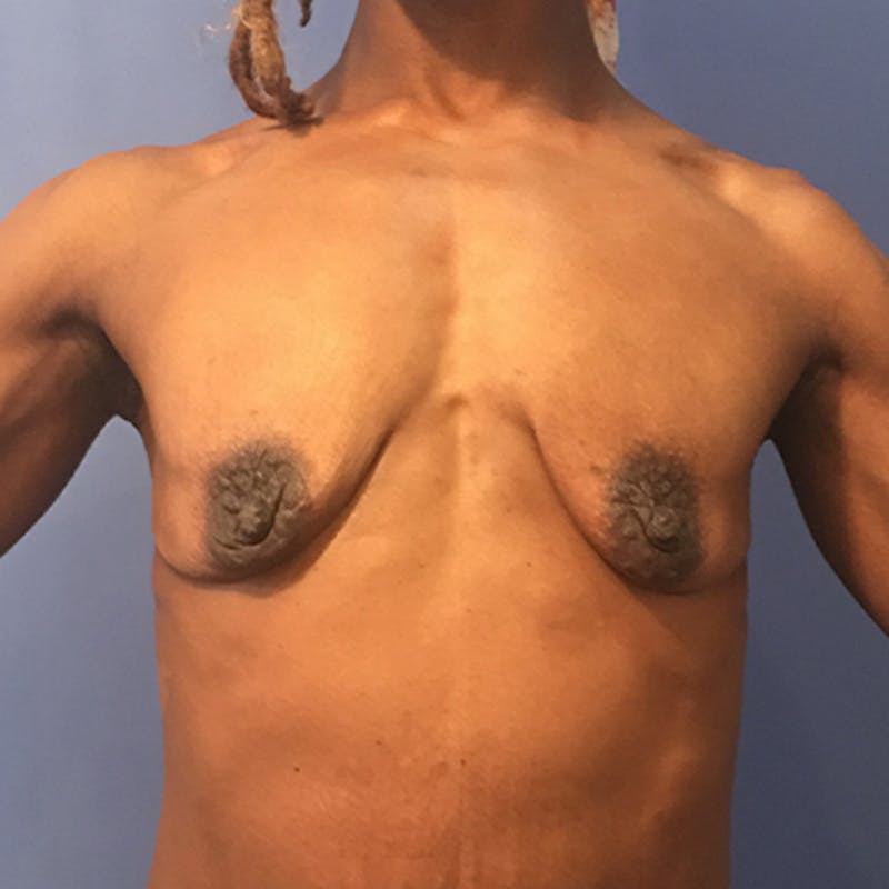 Breast Augmentation Before & After Gallery - Patient 929870 - Image 1