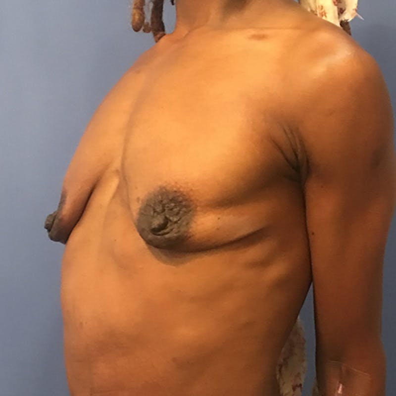 Breast Augmentation Before & After Gallery - Patient 929870 - Image 3