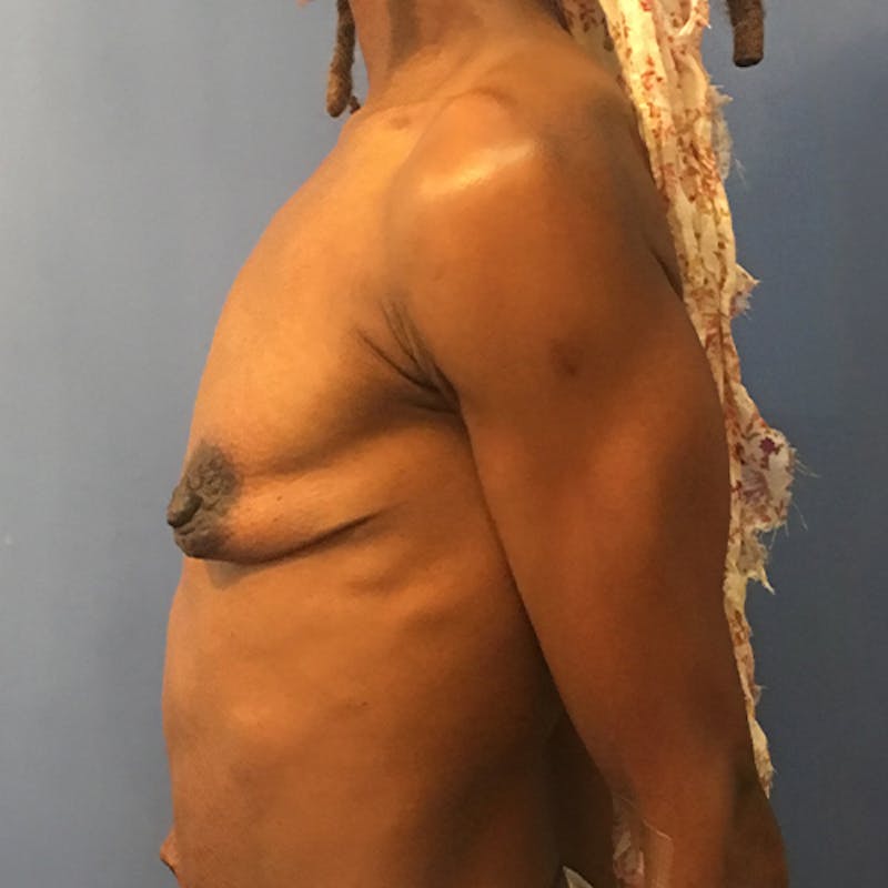 Breast Augmentation Before & After Gallery - Patient 929870 - Image 5