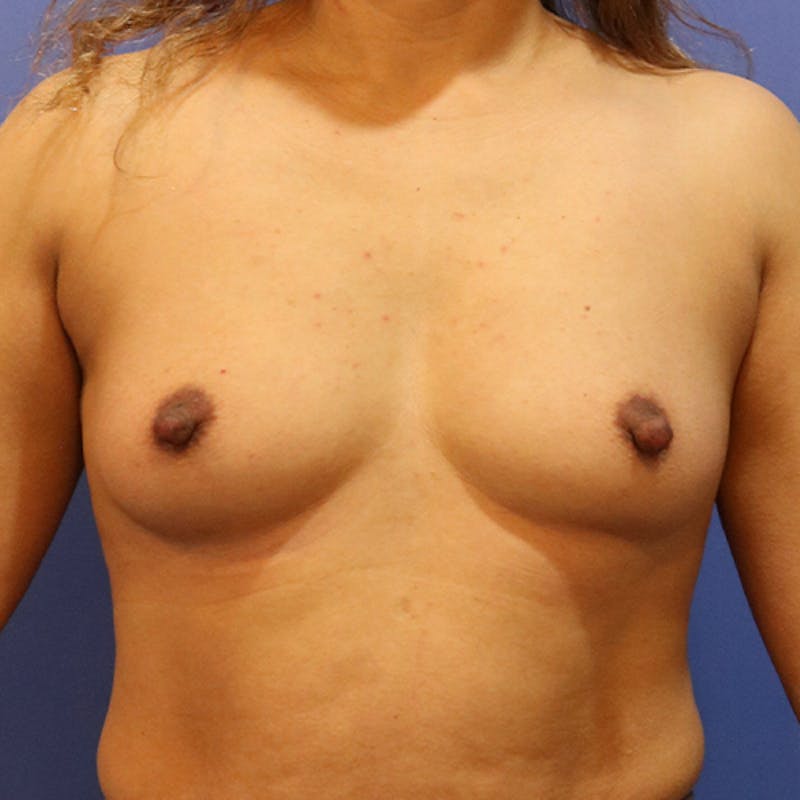 Breast Augmentation Before & After Gallery - Patient 395253 - Image 1