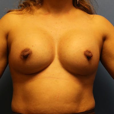 Breast Augmentation Before & After Gallery - Patient 395253 - Image 2