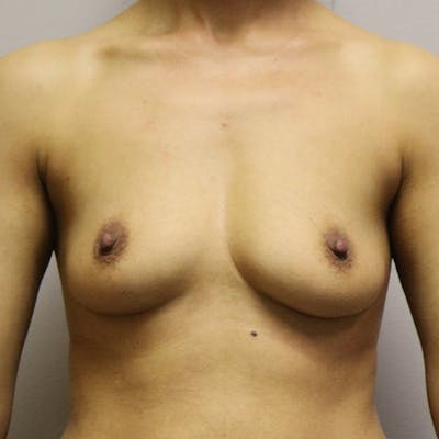 Breast Augmentation Before & After Gallery - Patient 193754 - Image 1