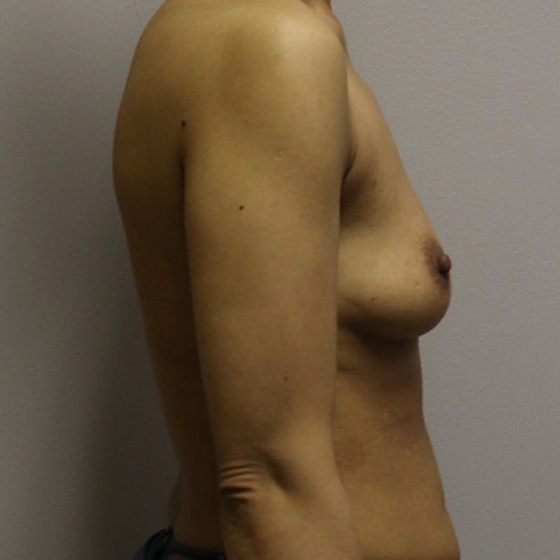 Breast Augmentation Before & After Gallery - Patient 193754 - Image 3