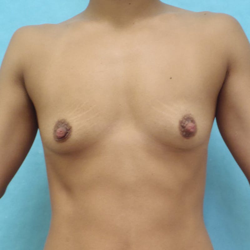 Breast Augmentation Before & After Gallery - Patient 126388 - Image 1