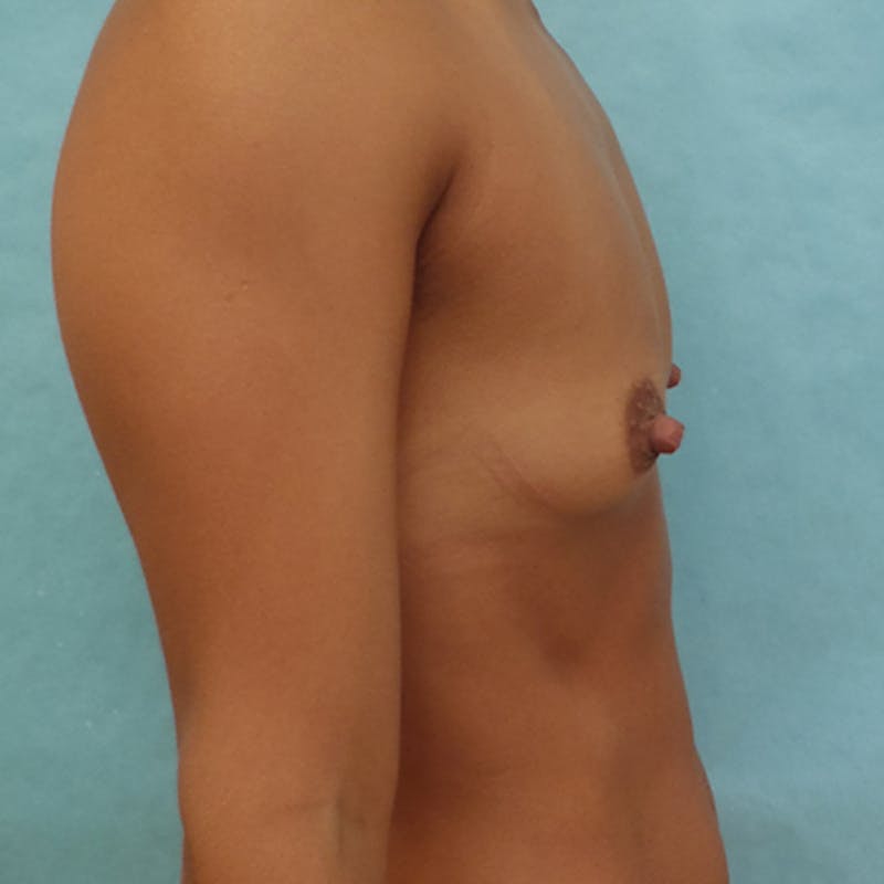 Breast Augmentation Before & After Gallery - Patient 126388 - Image 5