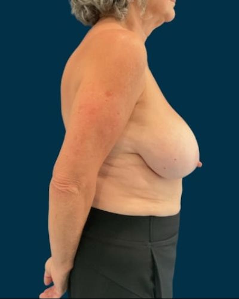 Breast Lift Before & After Gallery - Patient 415260 - Image 5