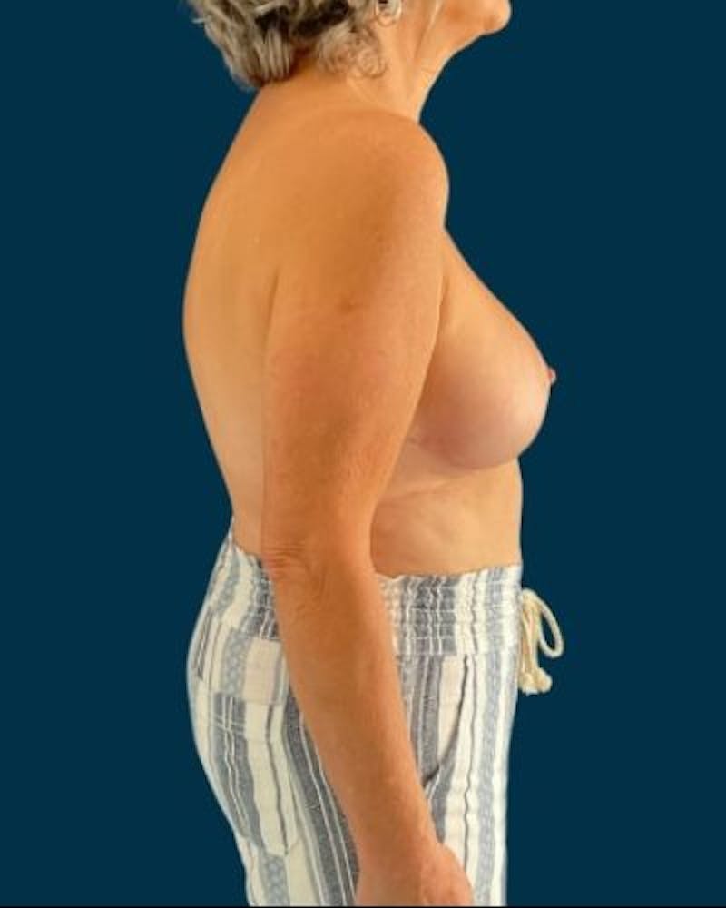 Breast Lift Before & After Gallery - Patient 415260 - Image 6