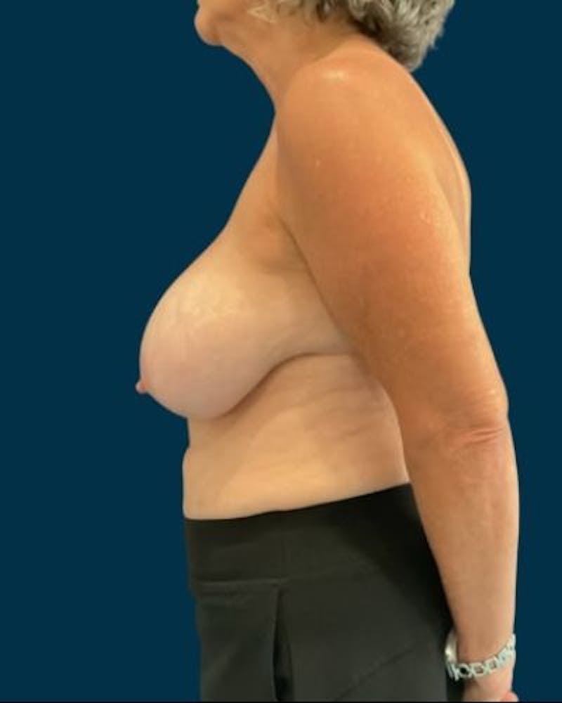 Breast Lift Before & After Gallery - Patient 415260 - Image 9