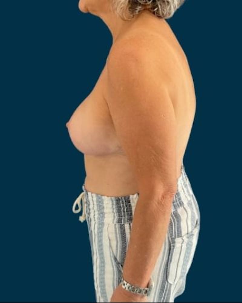 Breast Lift Before & After Gallery - Patient 415260 - Image 10