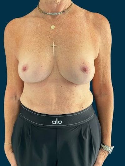 Breast Lift Before & After Gallery - Patient 287917 - Image 2