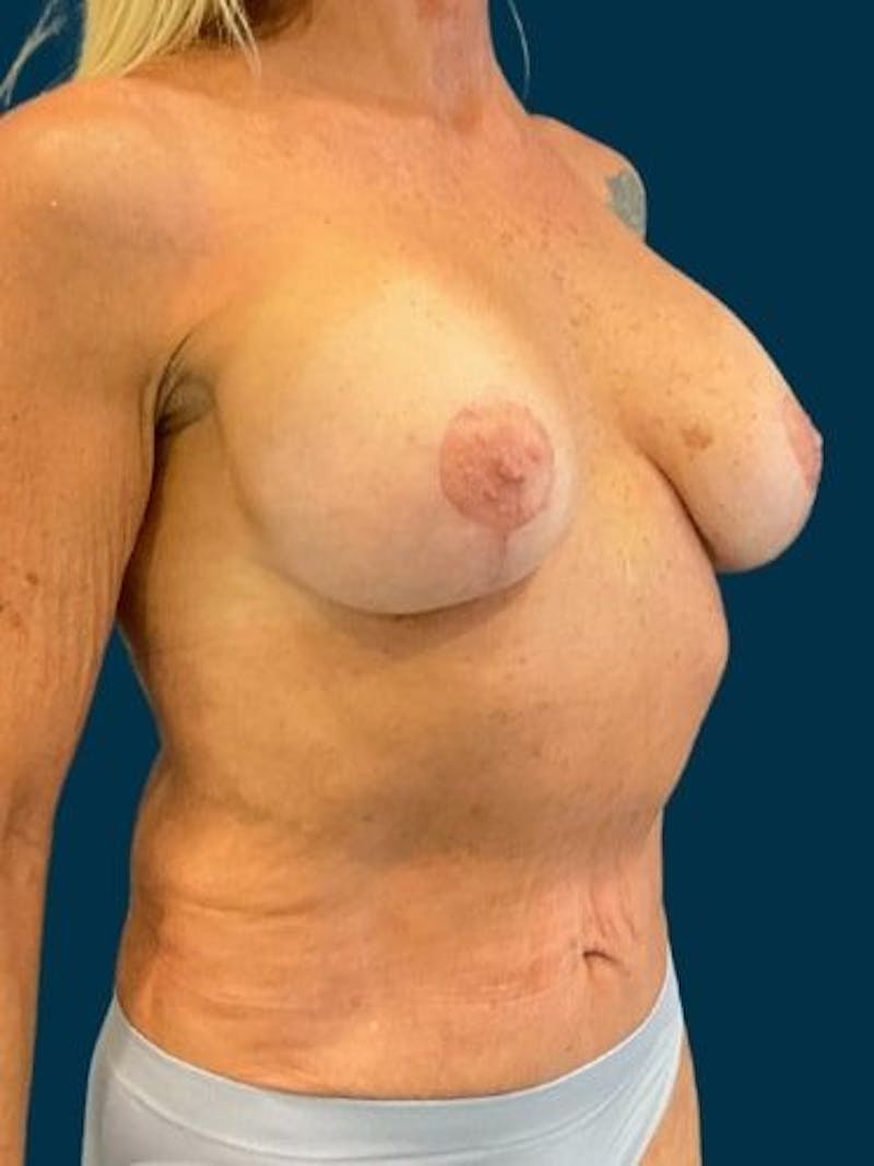 Breast Lift Before & After Gallery - Patient 368802 - Image 2