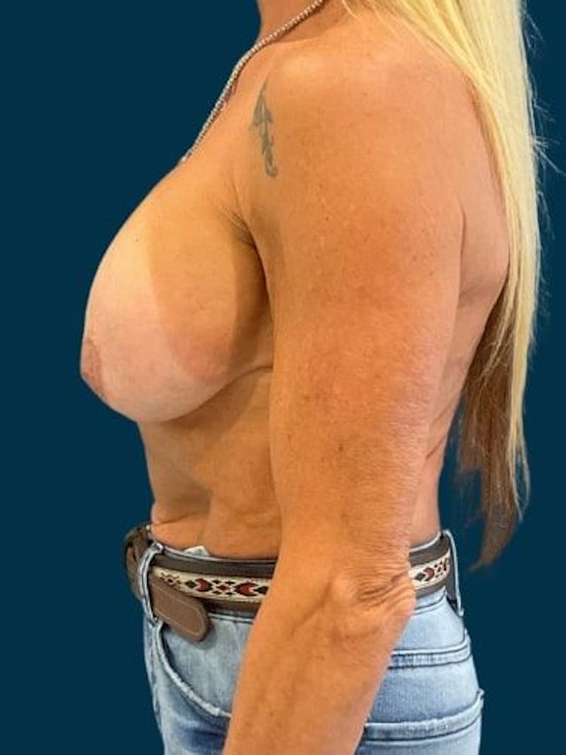 Breast Lift Before & After Gallery - Patient 368802 - Image 3