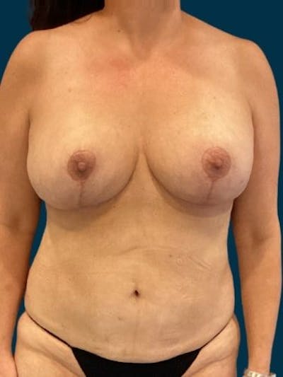 Breast Lift Before & After Gallery - Patient 396163 - Image 2