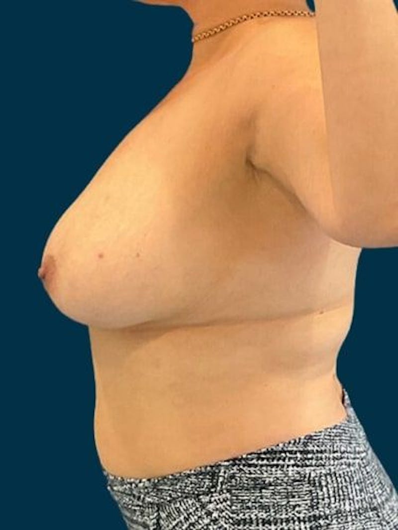 Breast Lift Before & After Gallery - Patient 396163 - Image 3