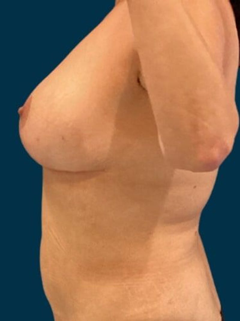 Breast Lift Before & After Gallery - Patient 396163 - Image 4