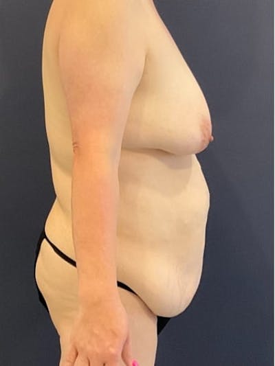 Breast Lift Before & After Gallery - Patient 157086 - Image 1