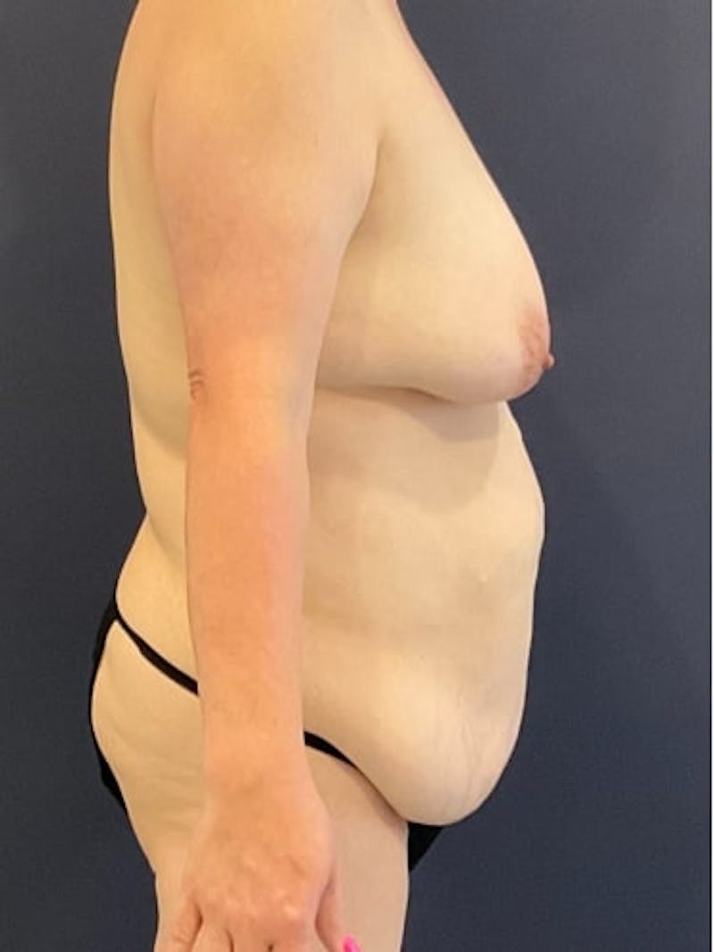 Breast Lift Before & After Gallery - Patient 157086 - Image 1