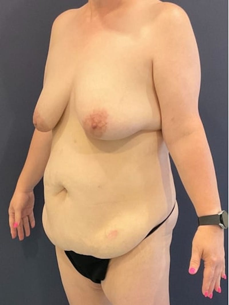 Breast Lift Before & After Gallery - Patient 157086 - Image 3
