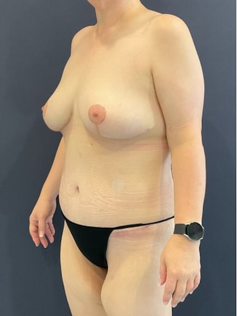 Breast Lift Before & After Gallery - Patient 157086 - Image 4