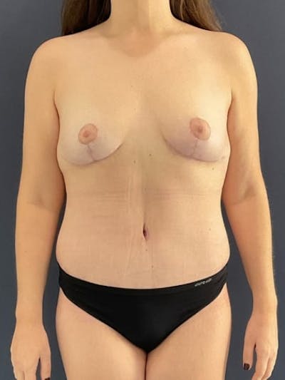 Breast Lift Before & After Gallery - Patient 372893 - Image 2