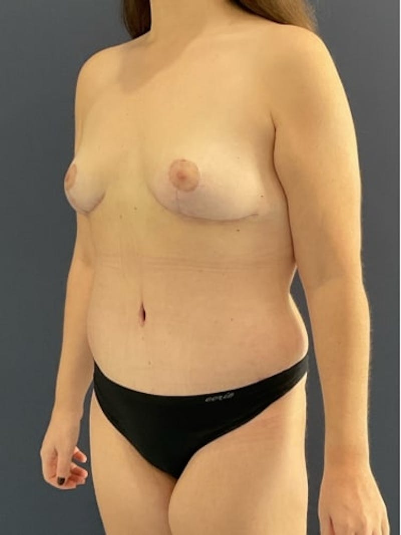 Breast Lift Before & After Gallery - Patient 372893 - Image 6