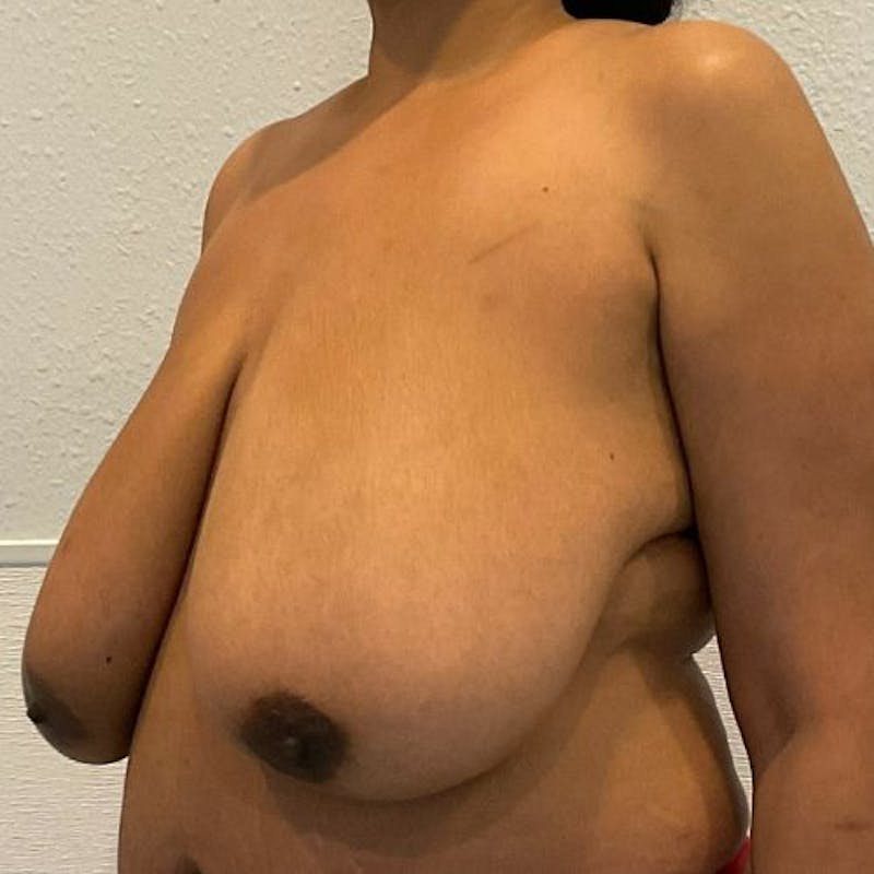 Breast Lift Before & After Gallery - Patient 148779 - Image 3