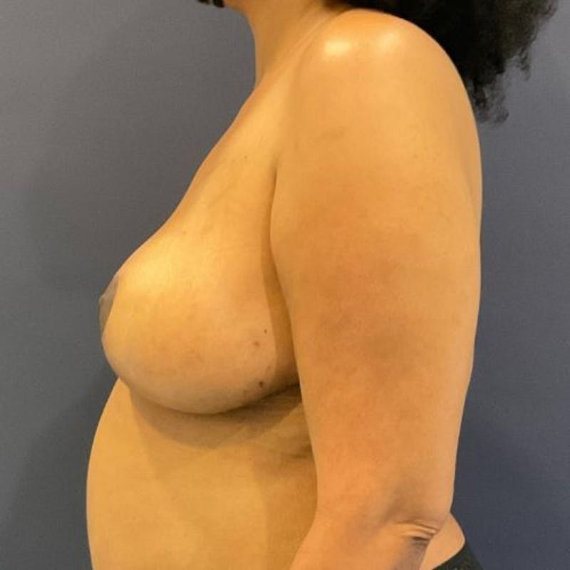 Breast Lift Before & After Gallery - Patient 148779 - Image 6