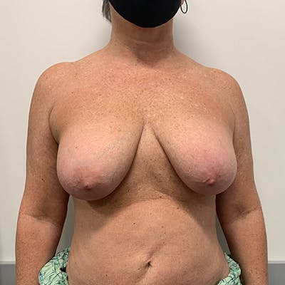 Breast Lift Before & After Gallery - Patient 404229 - Image 1