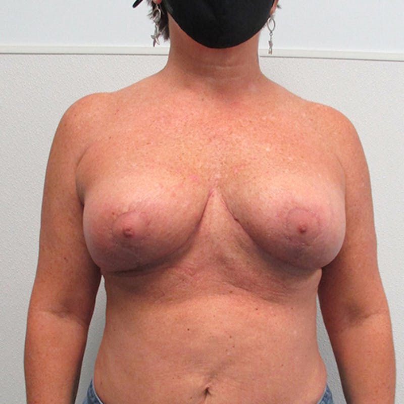 Breast Lift Before & After Gallery - Patient 404229 - Image 2