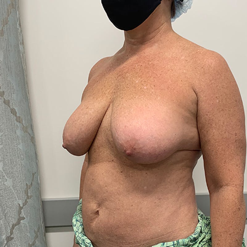 Breast Lift Before & After Gallery - Patient 404229 - Image 3