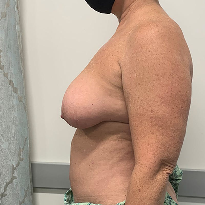 Breast Lift Before & After Gallery - Patient 404229 - Image 5