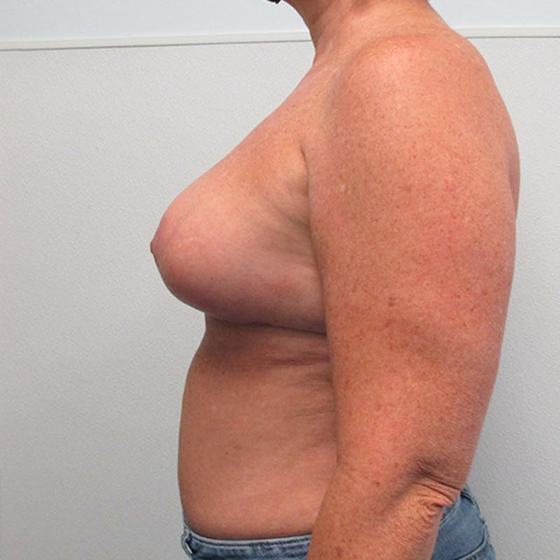Breast Lift Before & After Gallery - Patient 404229 - Image 6