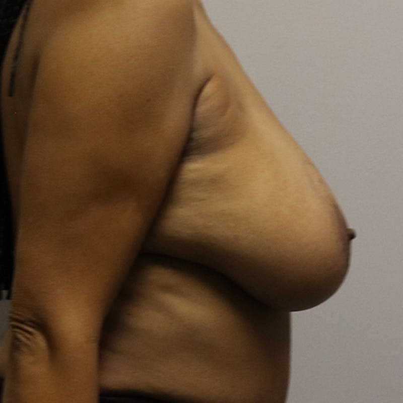 Breast Lift Before & After Gallery - Patient 283956 - Image 5