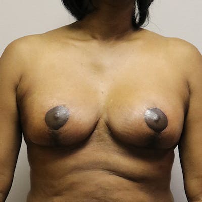Breast Lift Before & After Gallery - Patient 843161 - Image 2